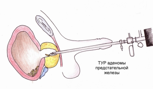 Препараты для лечение частого мочеиспускания у мужчин при простатите