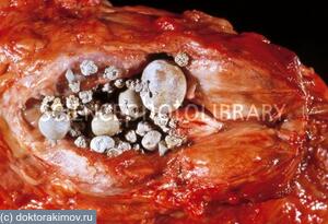 sostav-kamnej-prostaty-foto-2_CD5EE