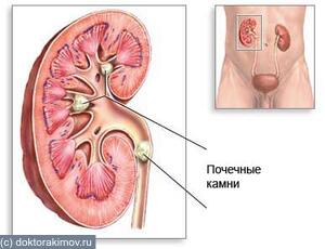 Мочекаменная болезнь